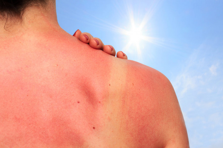 Мариупольцам на заметку: опасные мифы о лечении солнечных ожогов