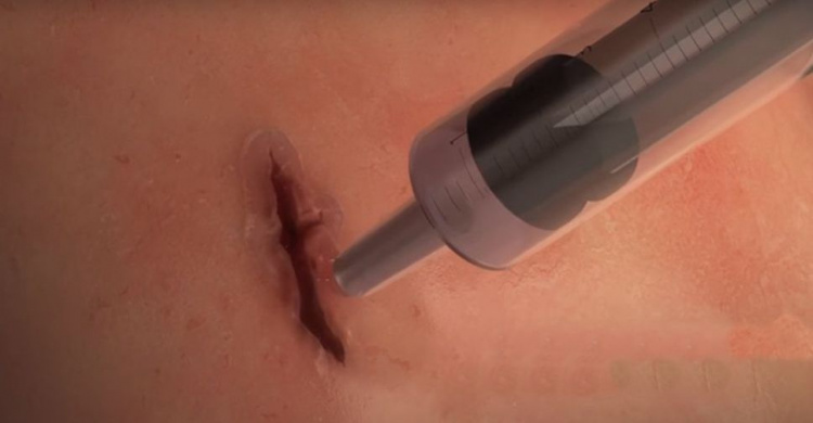 Ученые создали хирургический гель, стягивающий рану за 1 минуту