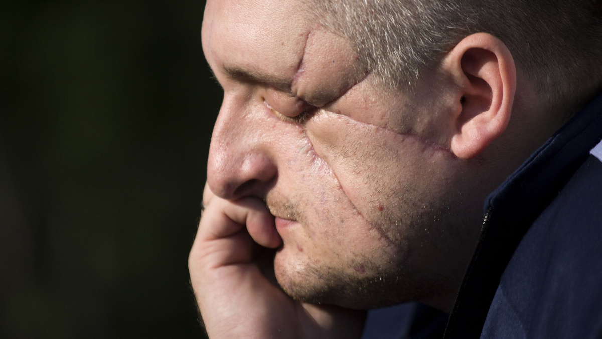 «Коли я отямився, мені аплодували» - ветеран, який втратив очі, став психологом та створив блог