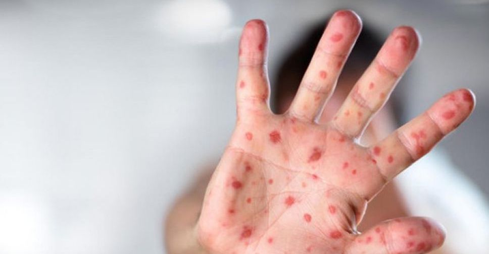 В Мариуполе выявлены первые случаи кори