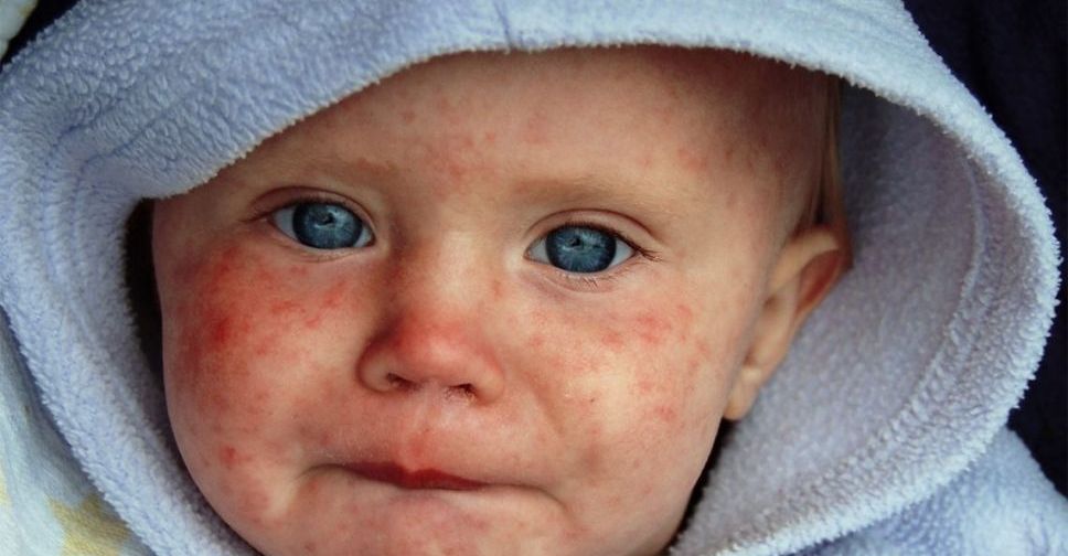 В Мариуполе 123 человека заболели корью менее чем за месяц