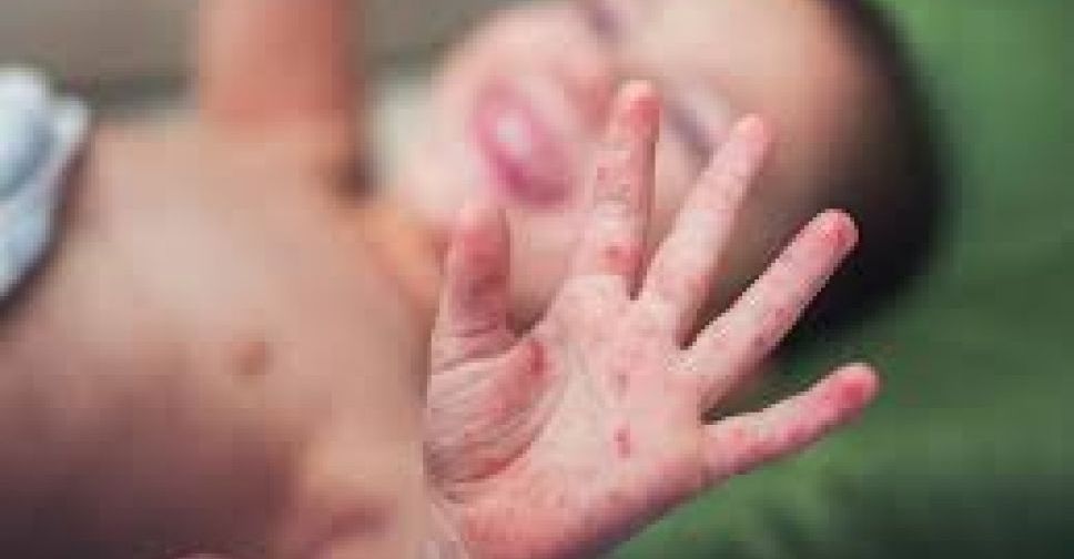 В Мариуполе заболевшие корью пошли на поправку