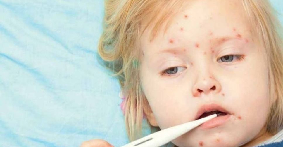 Новые случаи кори в Мариуполе: четверо заболевших, один из них – ребенок