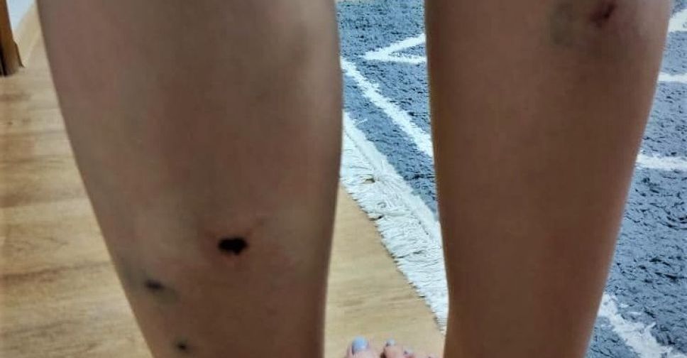 В Мариуполе уличные собаки напали на подростка. Жители просят не увозить животных со двора