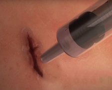 Ученые создали хирургический гель, стягивающий рану за 1 минуту