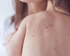 Новый год в «инфекционке»: в Мариуполе растет заболеваемость корью – пострадали 4 младенца