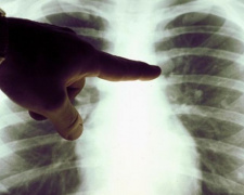 В Украине число больных пневмонией возросло в пять раз