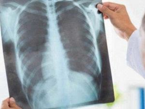 В Украине случаи заболевания пневмонией выросли в два раза