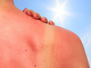 Мариупольцам на заметку: опасные мифы о лечении солнечных ожогов
