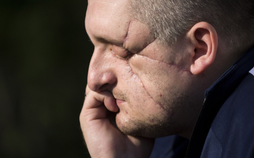 «Коли я отямився, мені аплодували» - ветеран, який втратив очі, став психологом та створив блог