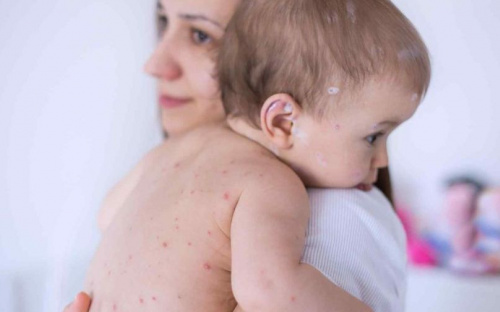 Более полсотни заболевших корью за неделю в Мариуполе