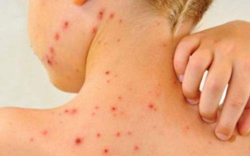В Мариуполе зарегистрировано 24 новых случая заболевания корью