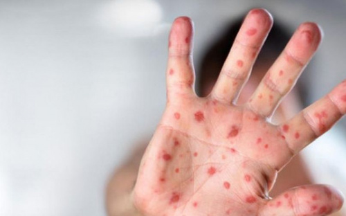 В Мариуполе выявлены первые случаи кори