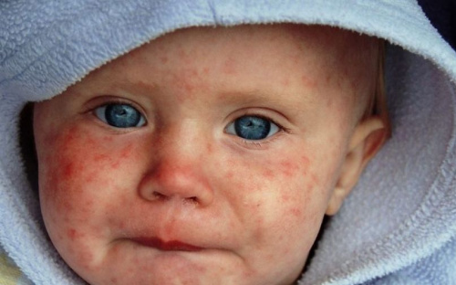 В Мариуполе 123 человека заболели корью менее чем за месяц
