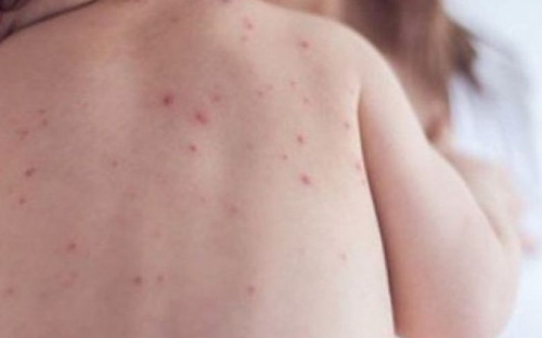 В Мариуполе еще 14 случаев кори за несколько дней. Вспышка повторяется?