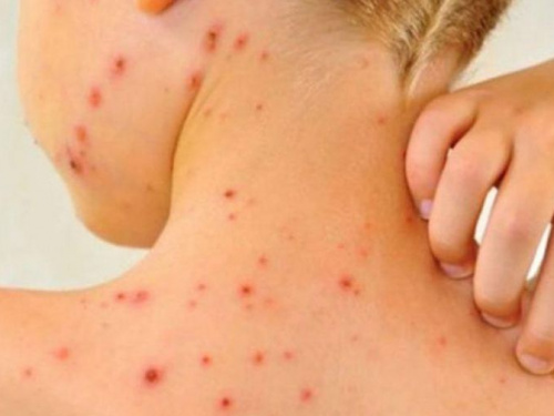 В Мариуполе зарегистрировано 24 новых случая заболевания корью