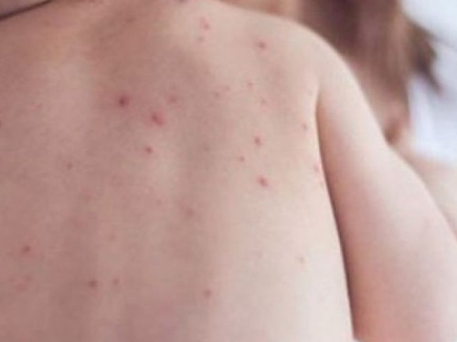 В Мариуполе еще 14 случаев кори за несколько дней. Вспышка повторяется?
